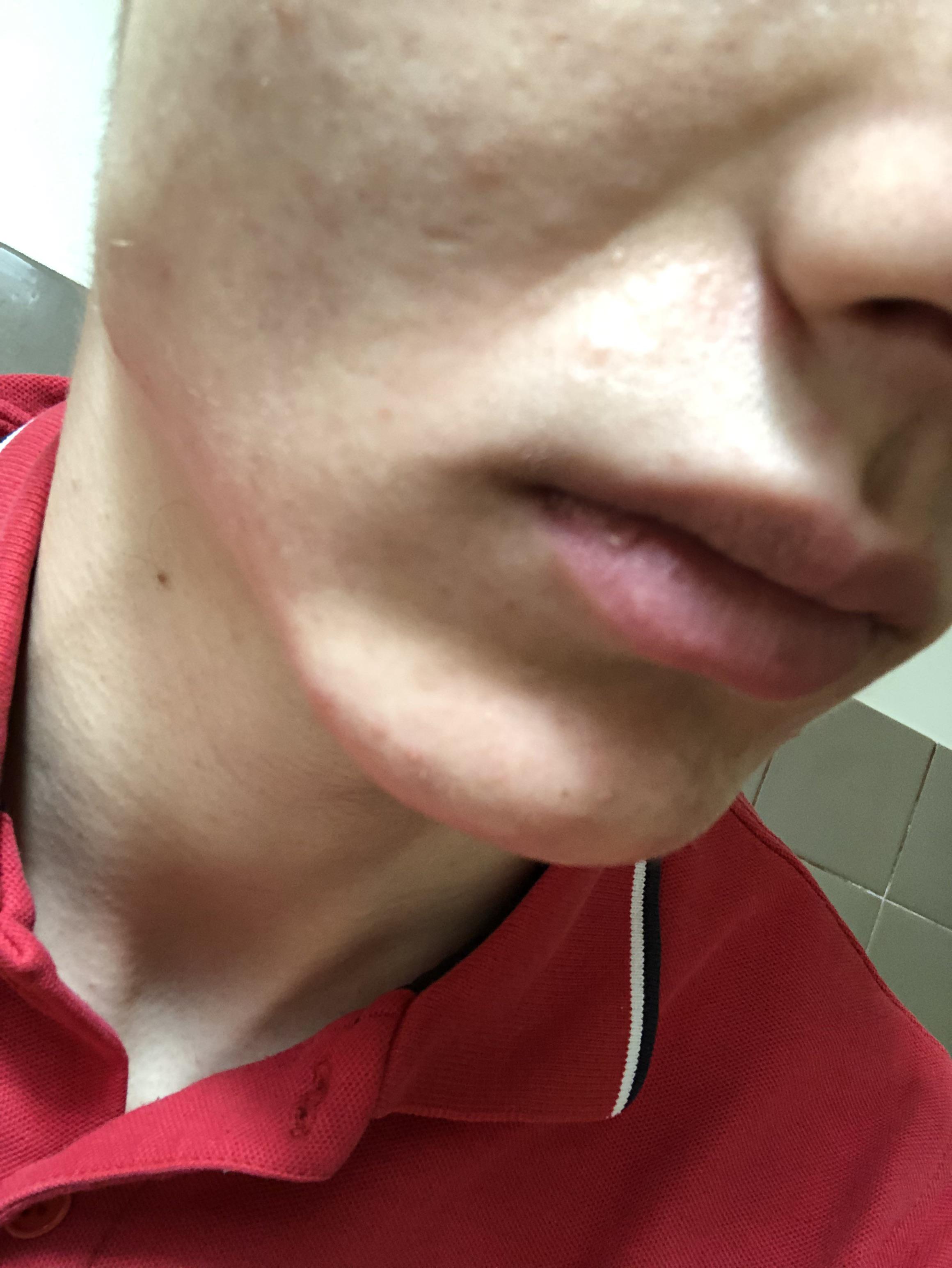 Skin concerns i m a 20 year old male these nasolabial lines v0 je8nty5ym6n81