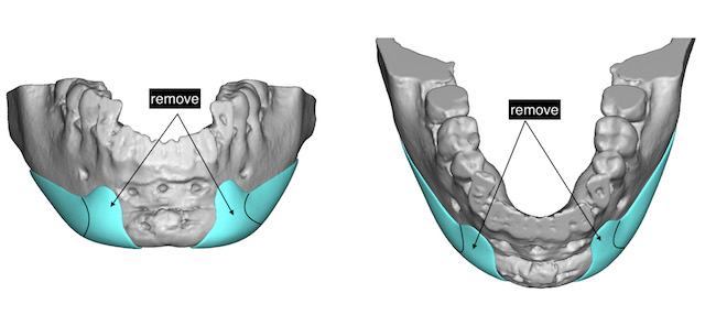 Custom Lateral Chin Implants design Dr Barry Eppley Indianapolis 1