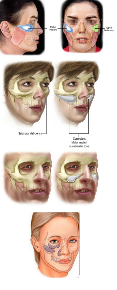 Midface augmentations