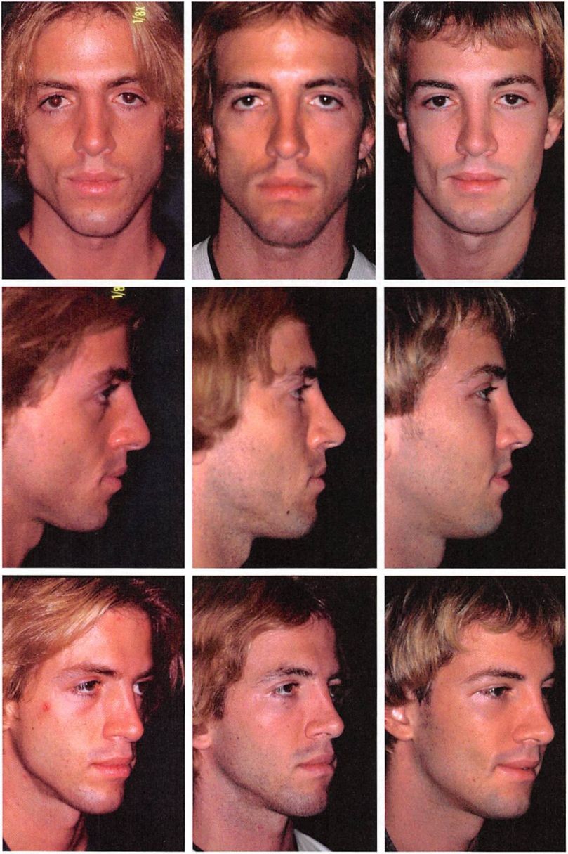 Midface implant yaremchuk