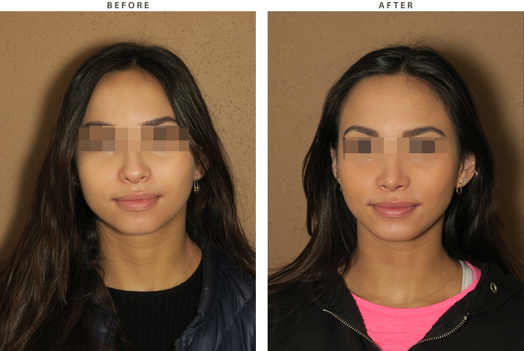 Rhinoplasty chin augmentation before after 6499 01