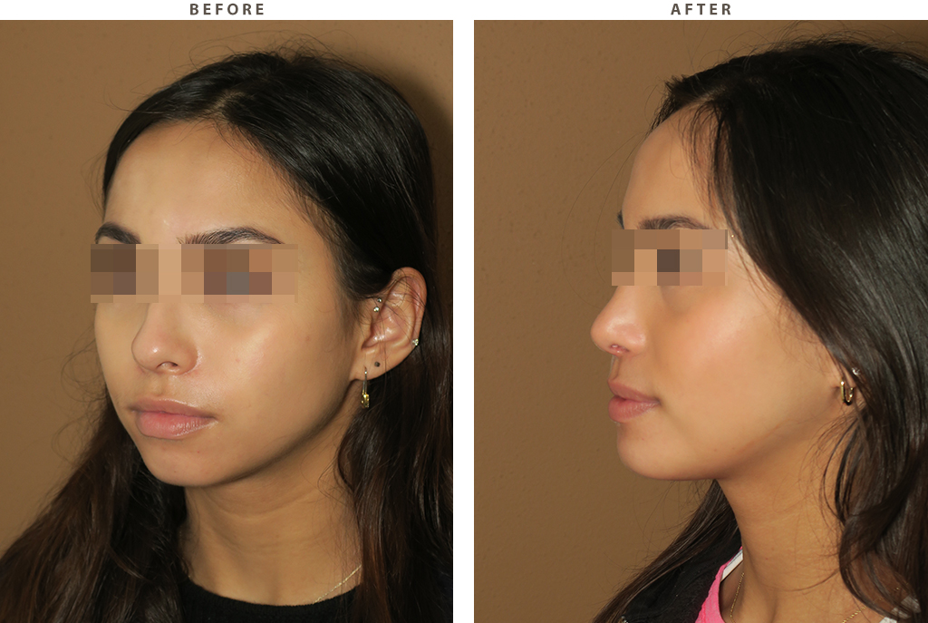 Rhinoplasty chin augmentation before after 6499 02