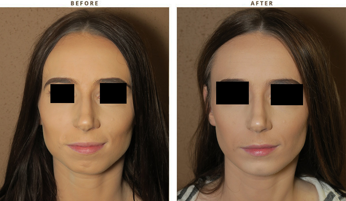 Chin before and after pictures 372