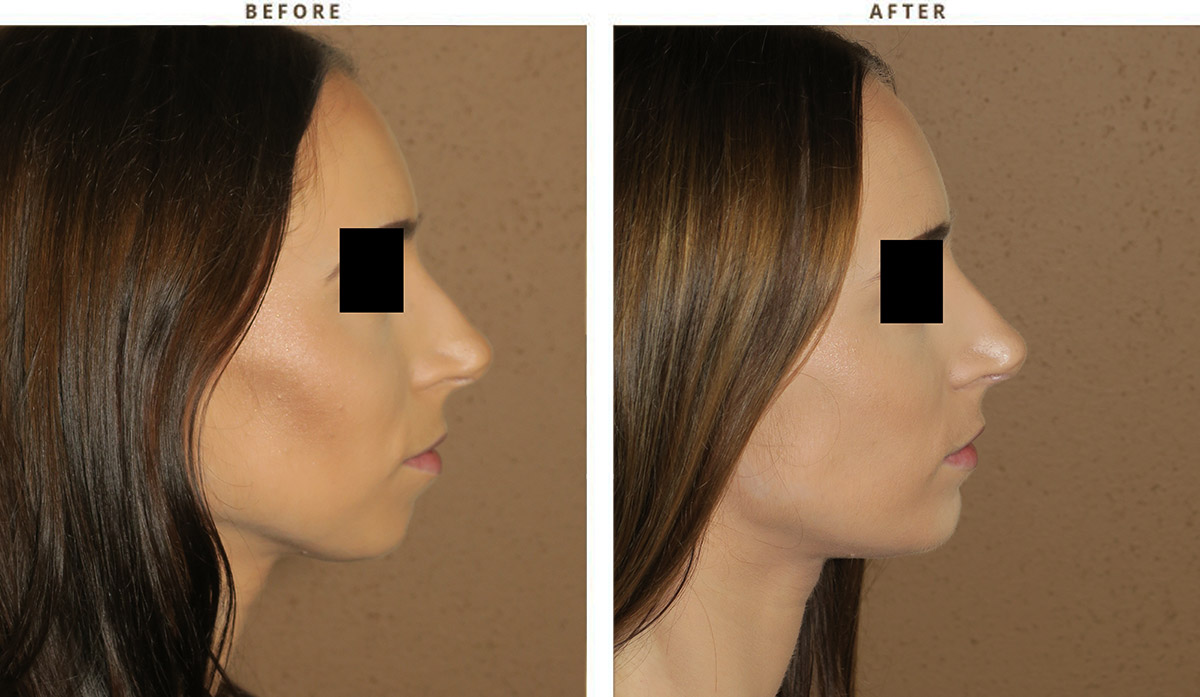 Chin before and after pictures 374