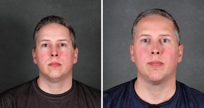 Case 5711 genioplasty before after