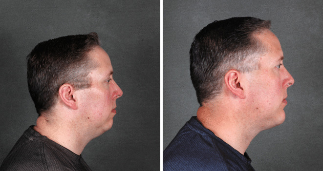 Case 5711 genioplasty before after 2