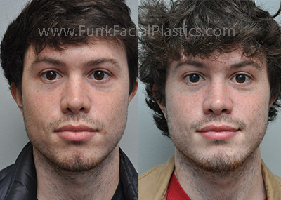 SD 1 Frontal Chin implant 1mo ba 