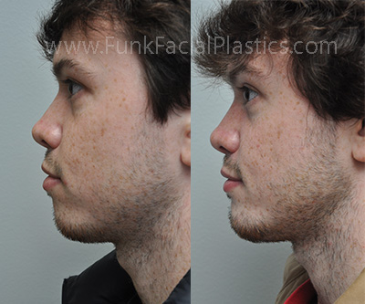 SD 2 L Profile Chin implant 1mo ba 