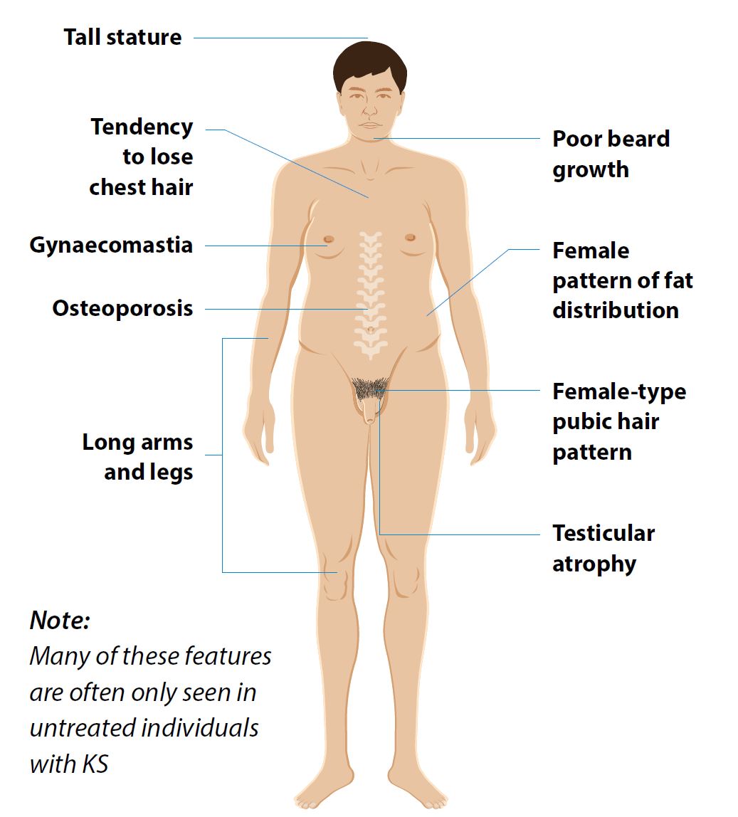 What are the features of klinefelter syndrome
