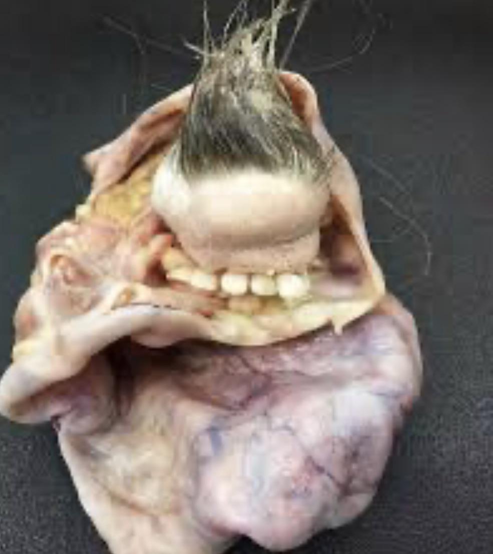 This is what a teratoma a tumor that can grow teeth eyes v0 417z4kodjtoa1