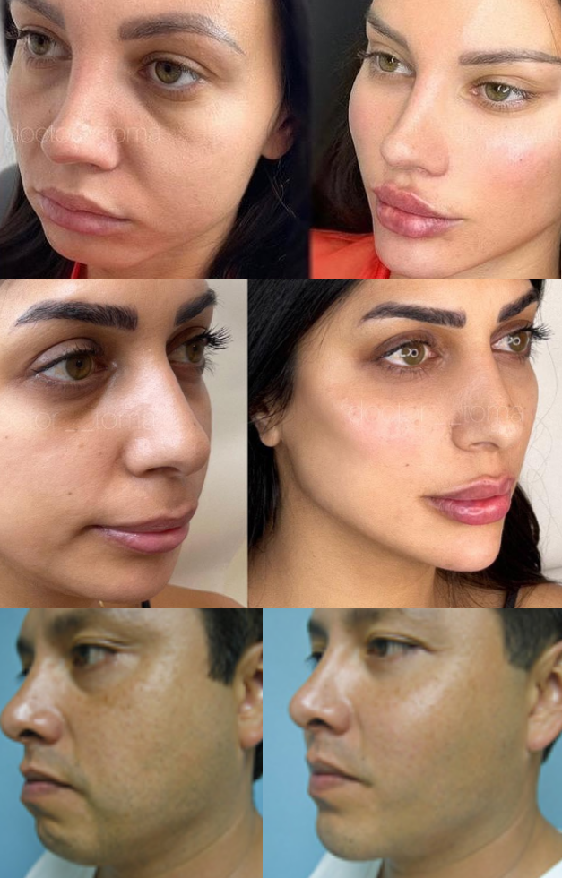 Malar augmentation