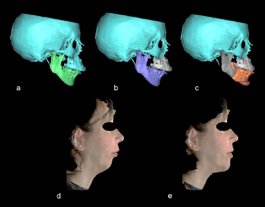 Bimaxillary orthognathic surgery