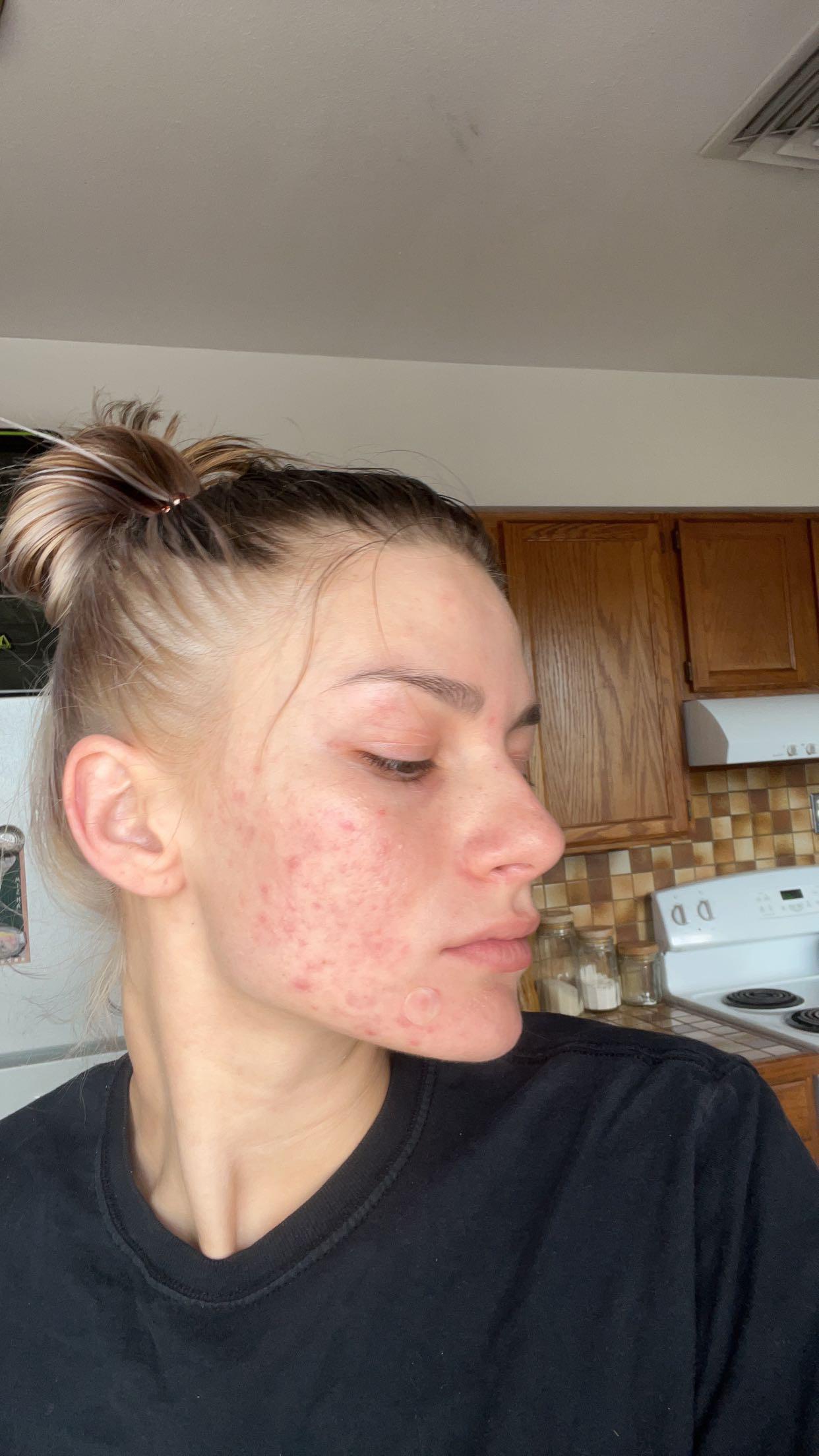 Beforeafter the power of treti2