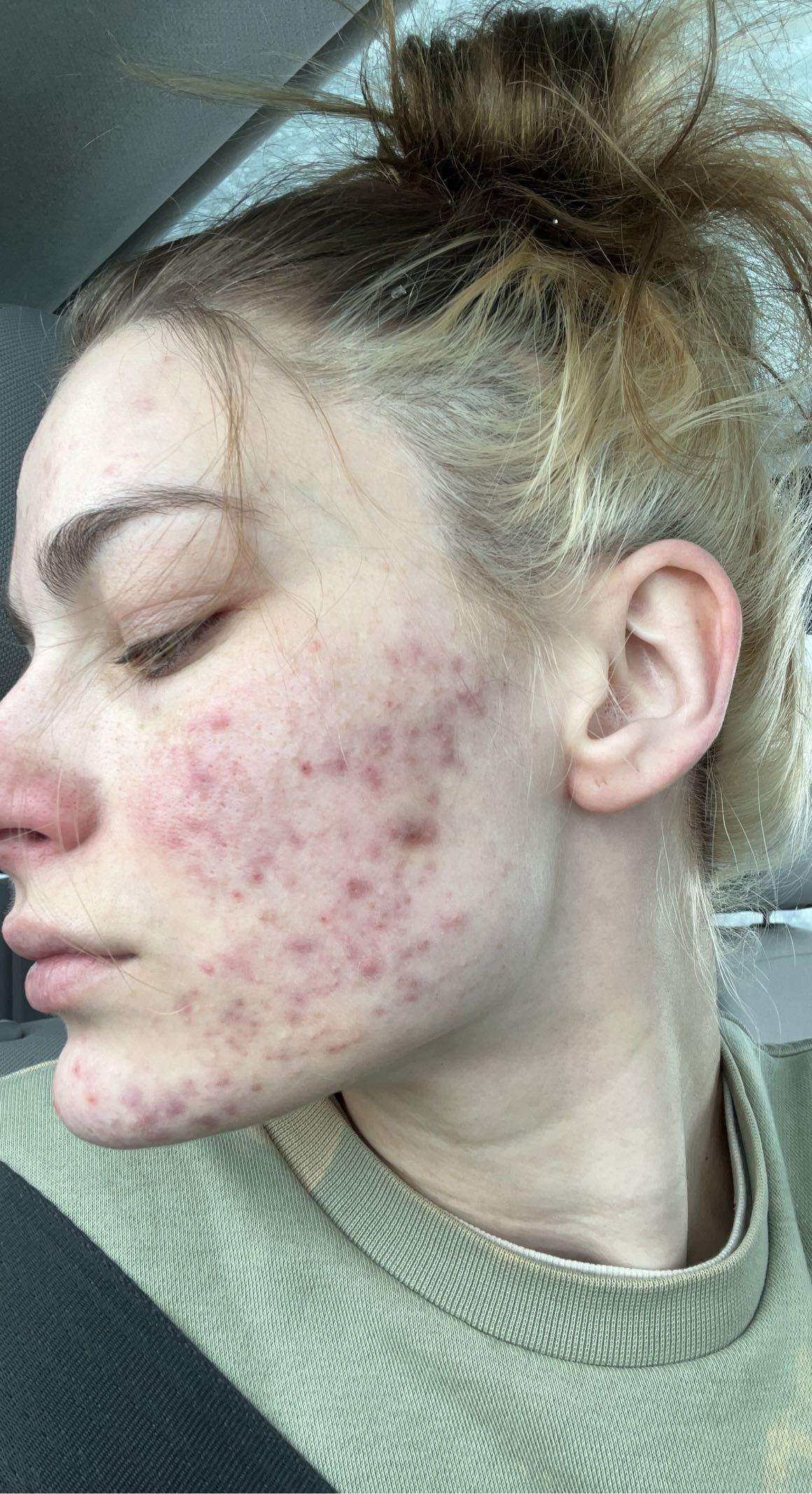 Beforeafter the power of treti3