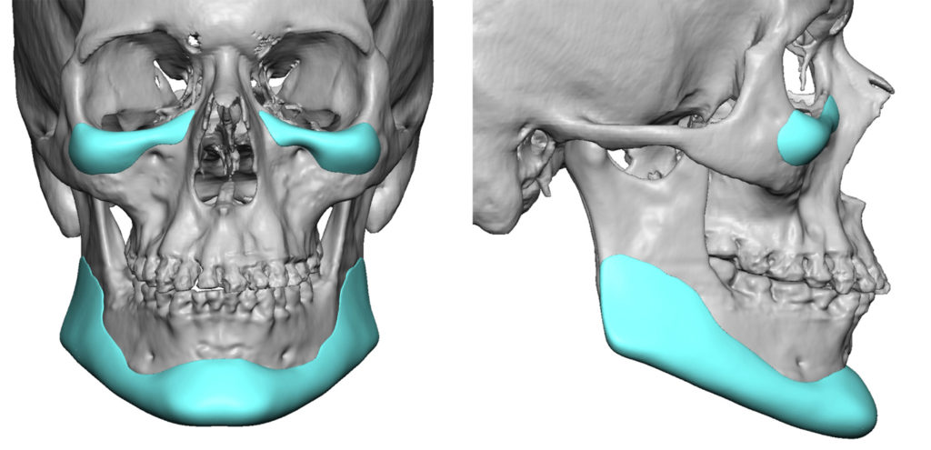 1 Male Custom Infraorbital and Jawline Implants Dr Barry Eppley Indianapolis 1024x495
