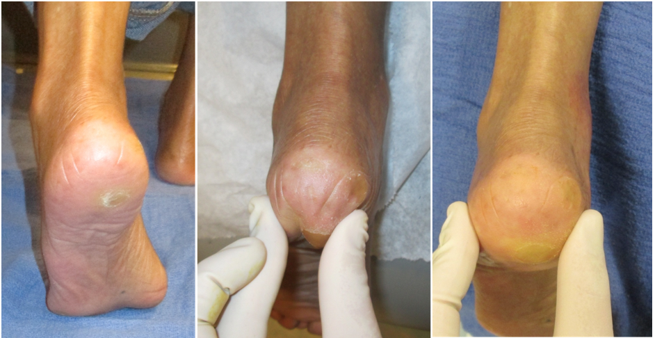 Autologous Fat Grafting For Pedal Fat Atrophy