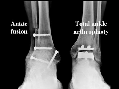 Seaview Orthopaedic arthrodesis right and left ankle arthroplasty