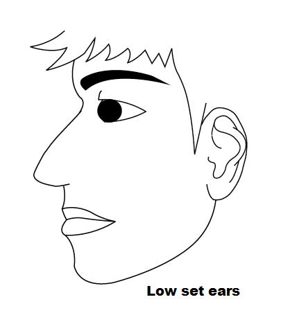 Low set ears