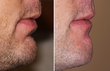 Dermal Fat Graft for Labiomenbtal Fold result Dr Barry Eppley Indianapolis 2