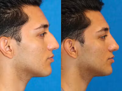Non surgical rhino male 1