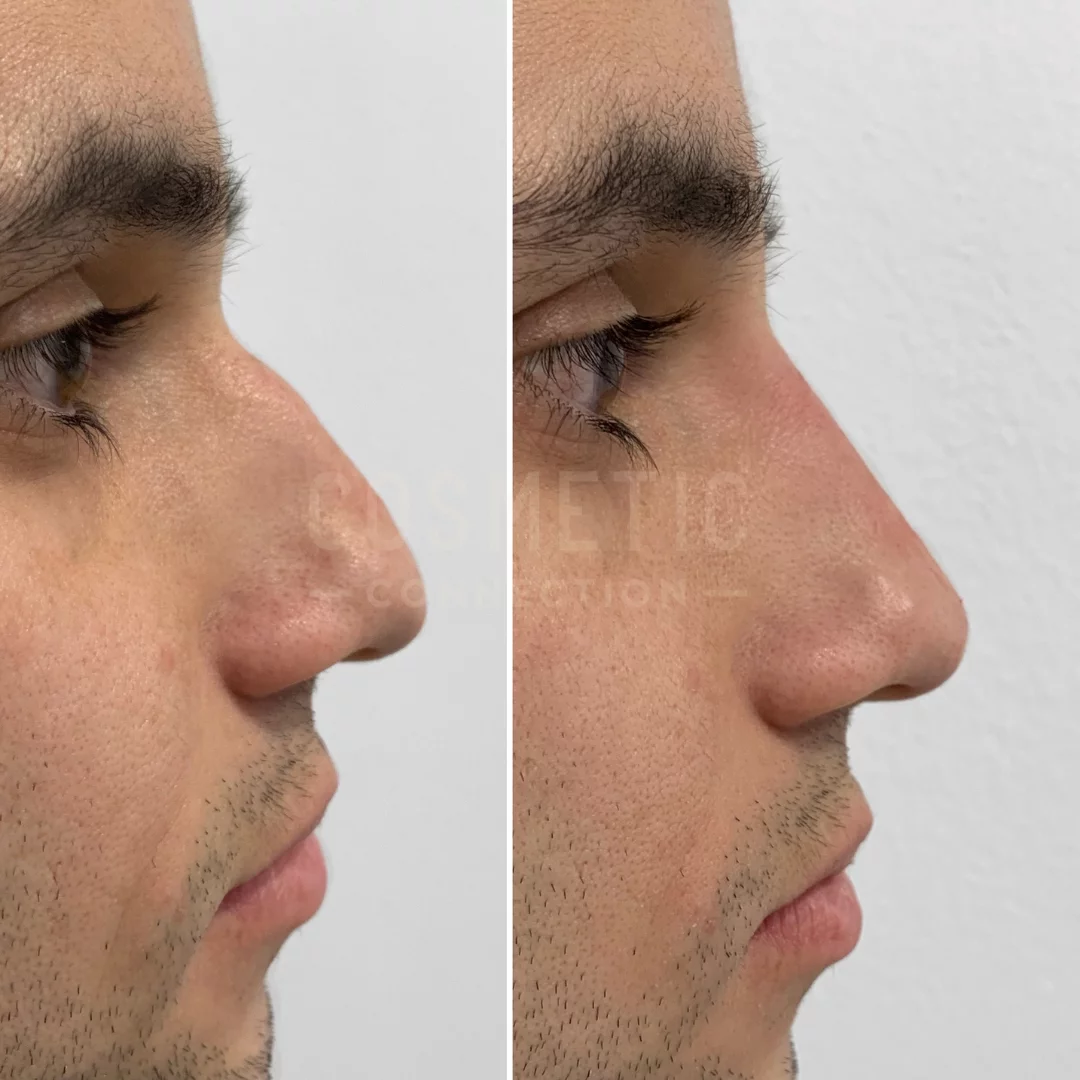 Non surgical rhino male 2