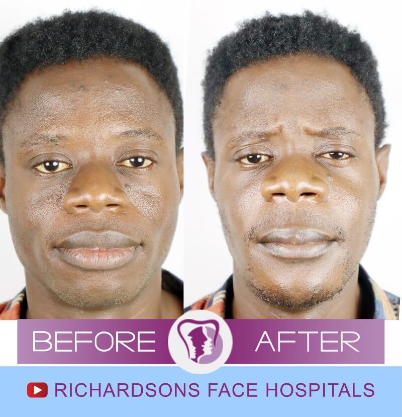 Terry Bijaw Surgery