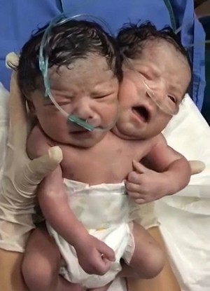2017010720the conjoined twins have their own brains and head but share a single body