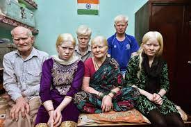 Albino indians Albino indians