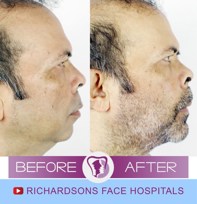 Bijaw Surgery Godfrey Dias