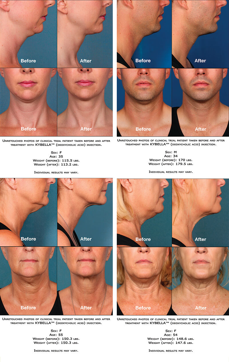 Kybella 4 5