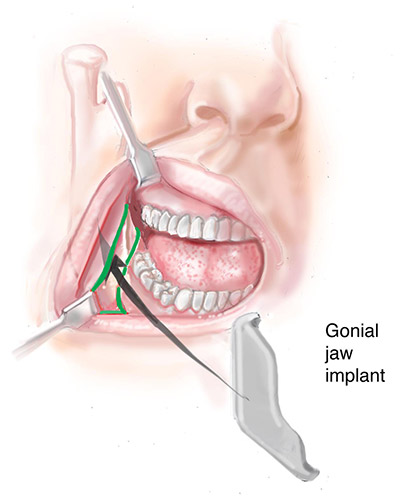Jaw implant incision