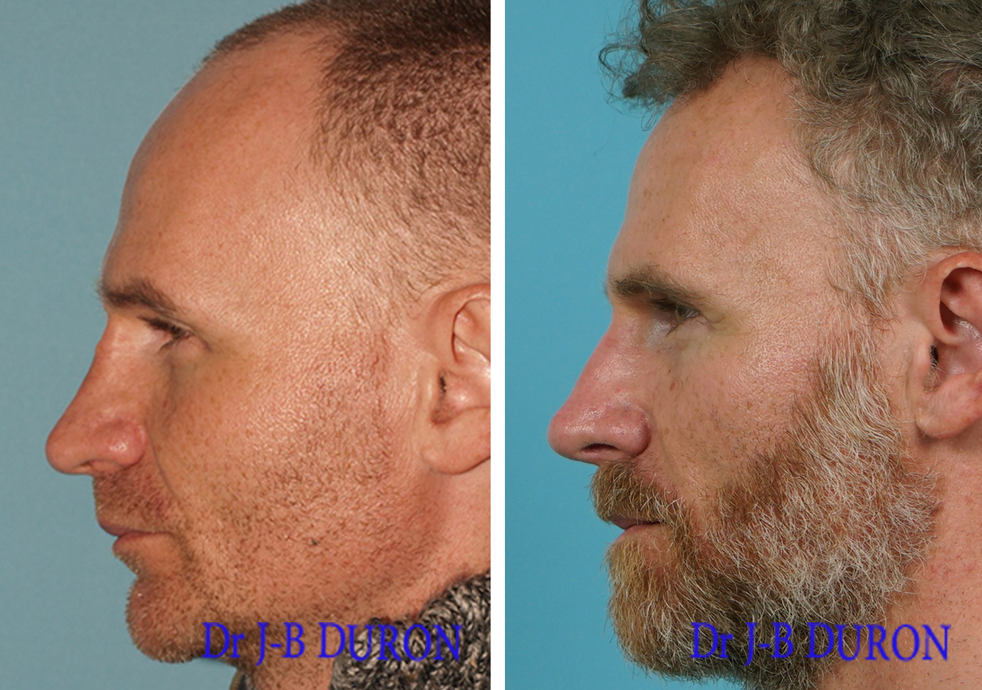 Duron rhinoplastie secondaire homme 31
