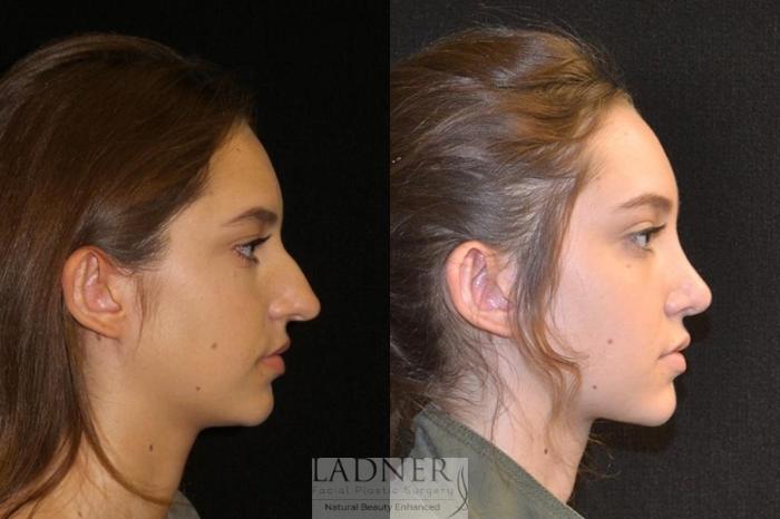 Rhinoplasty nose job 19 right side thumbnail