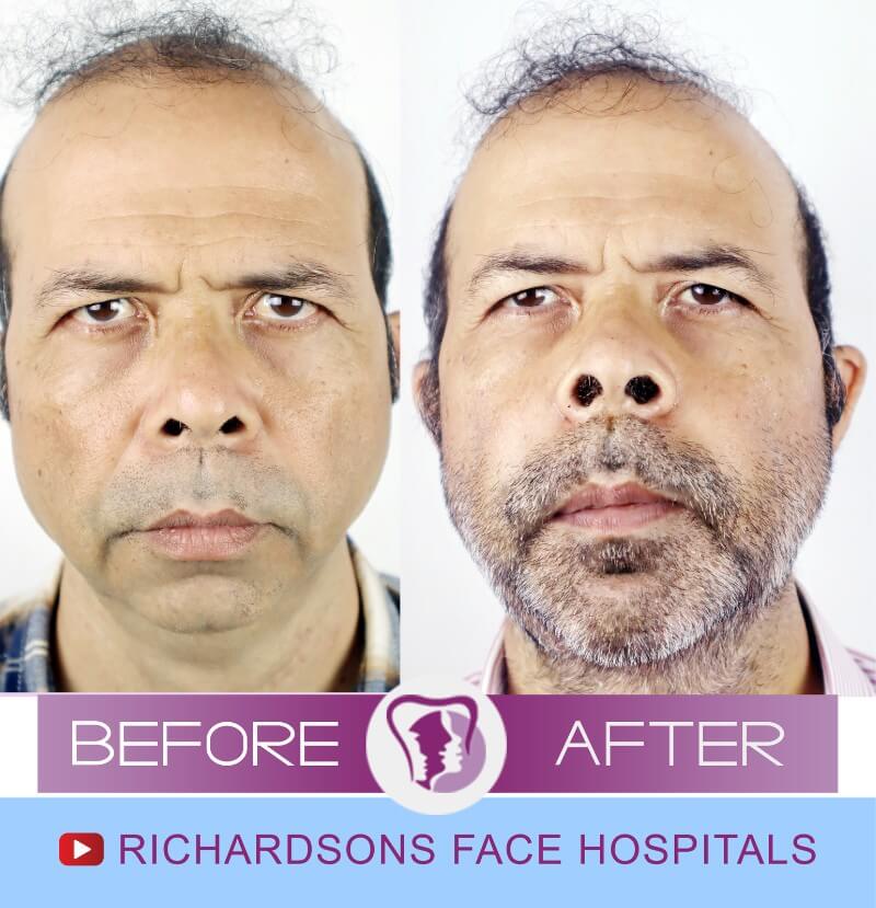 Godfrey Dias Bijaw Surgery