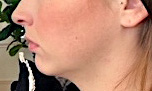 Petite female custiom jawline implant side 1 Dr Barry Eppley Indianapolis