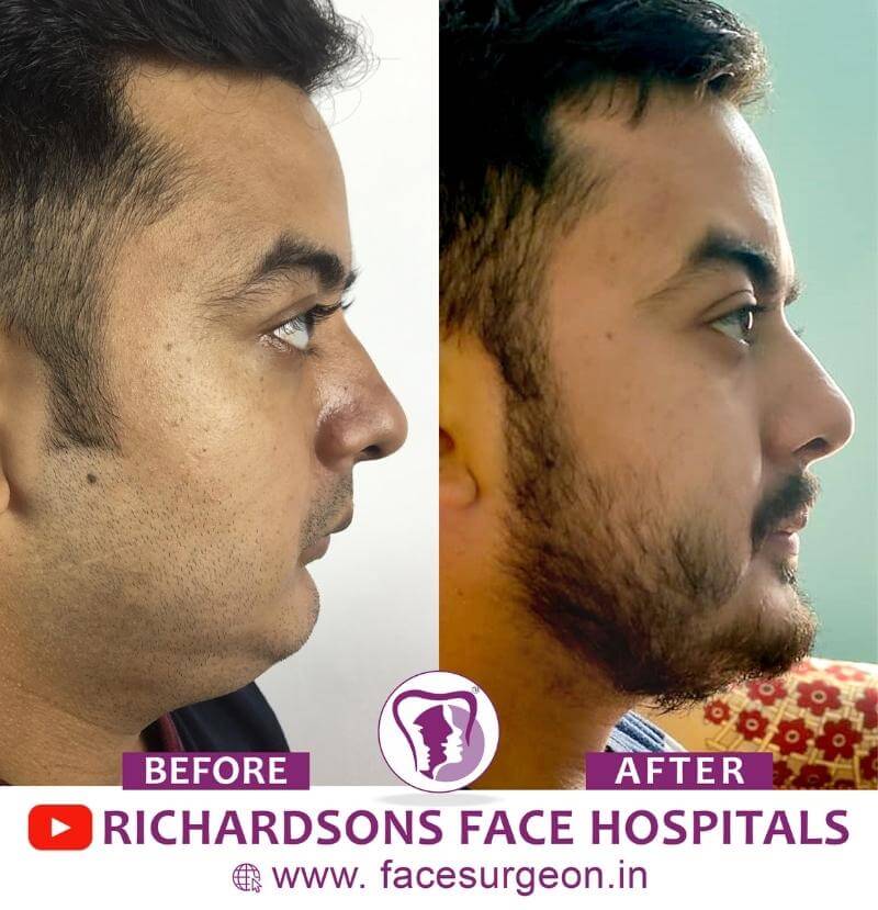 Genioplasty Before and After Results