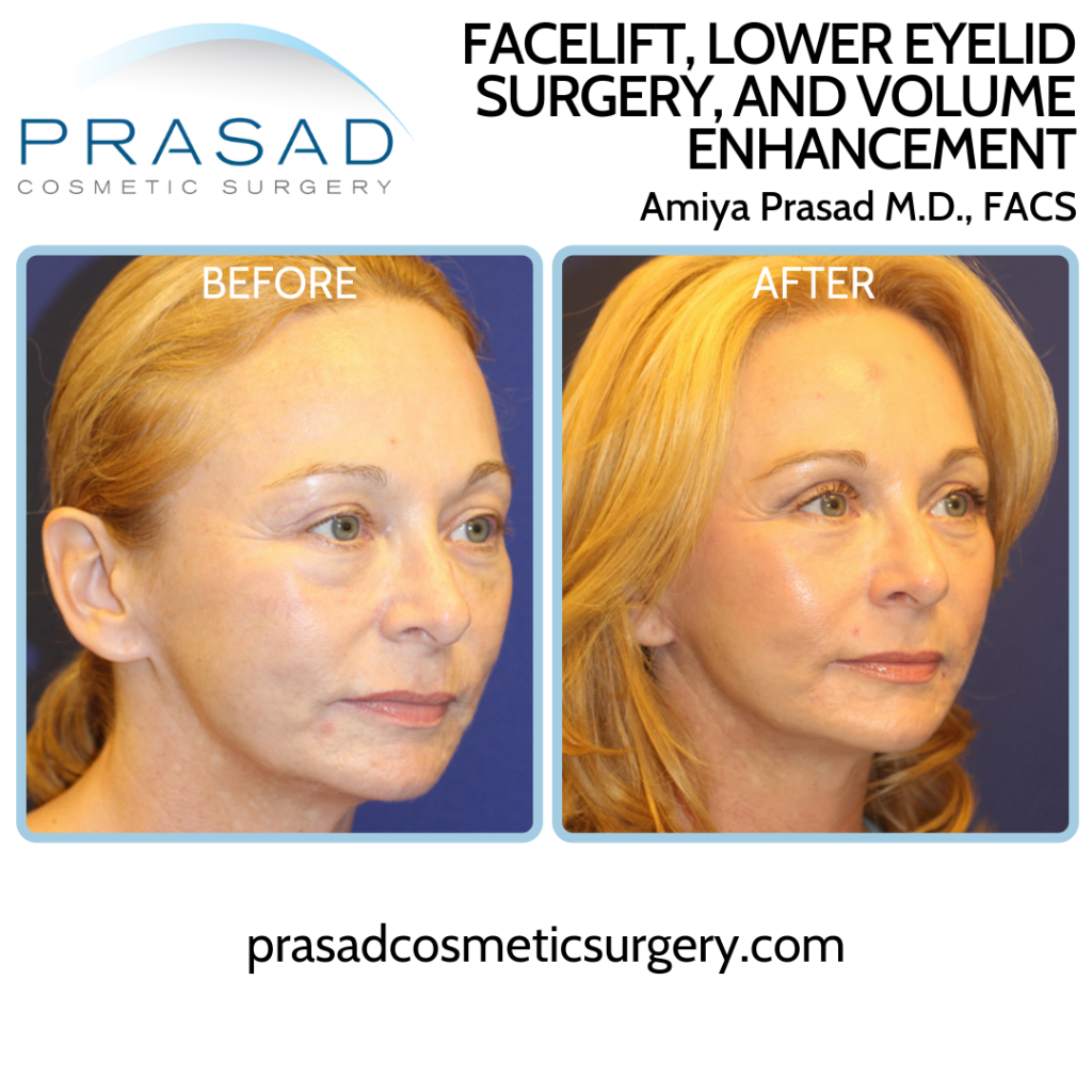 Facelift and eyelift before and after results quarter view 1024x1024