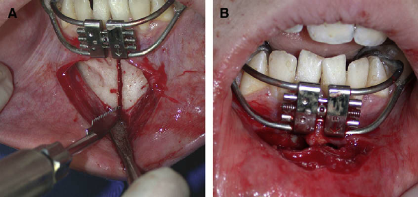 MSDO-surgery-A-bone-separation-B-periosteum-suture.png