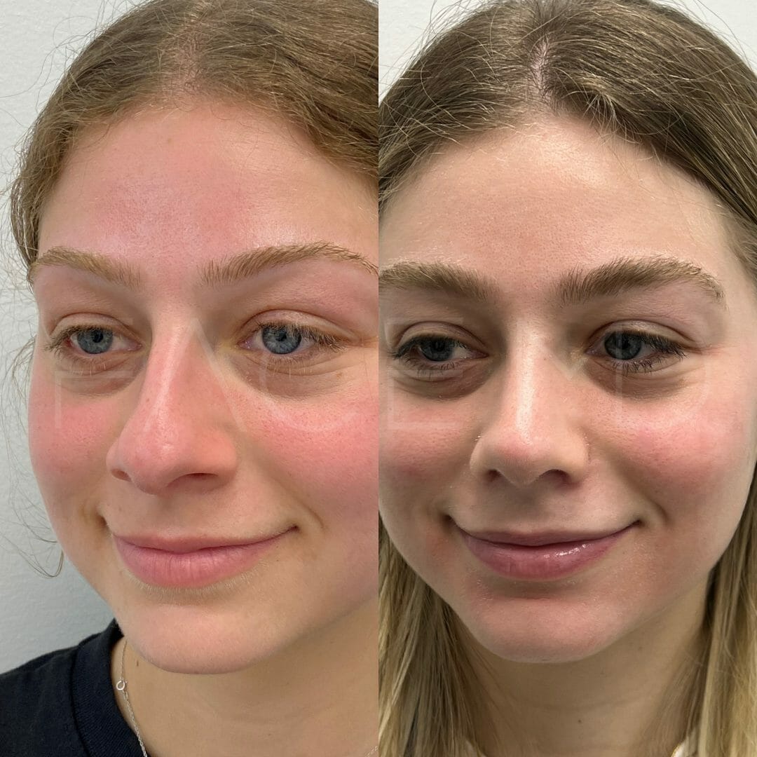 Rhinoplasty alar base reduction 3 2