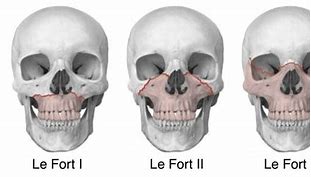 Image result for lefort 2
