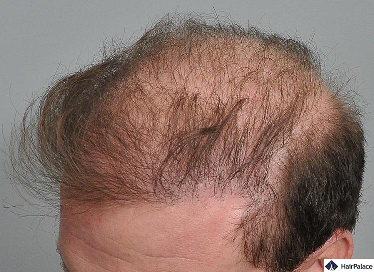 Failed hair transplant