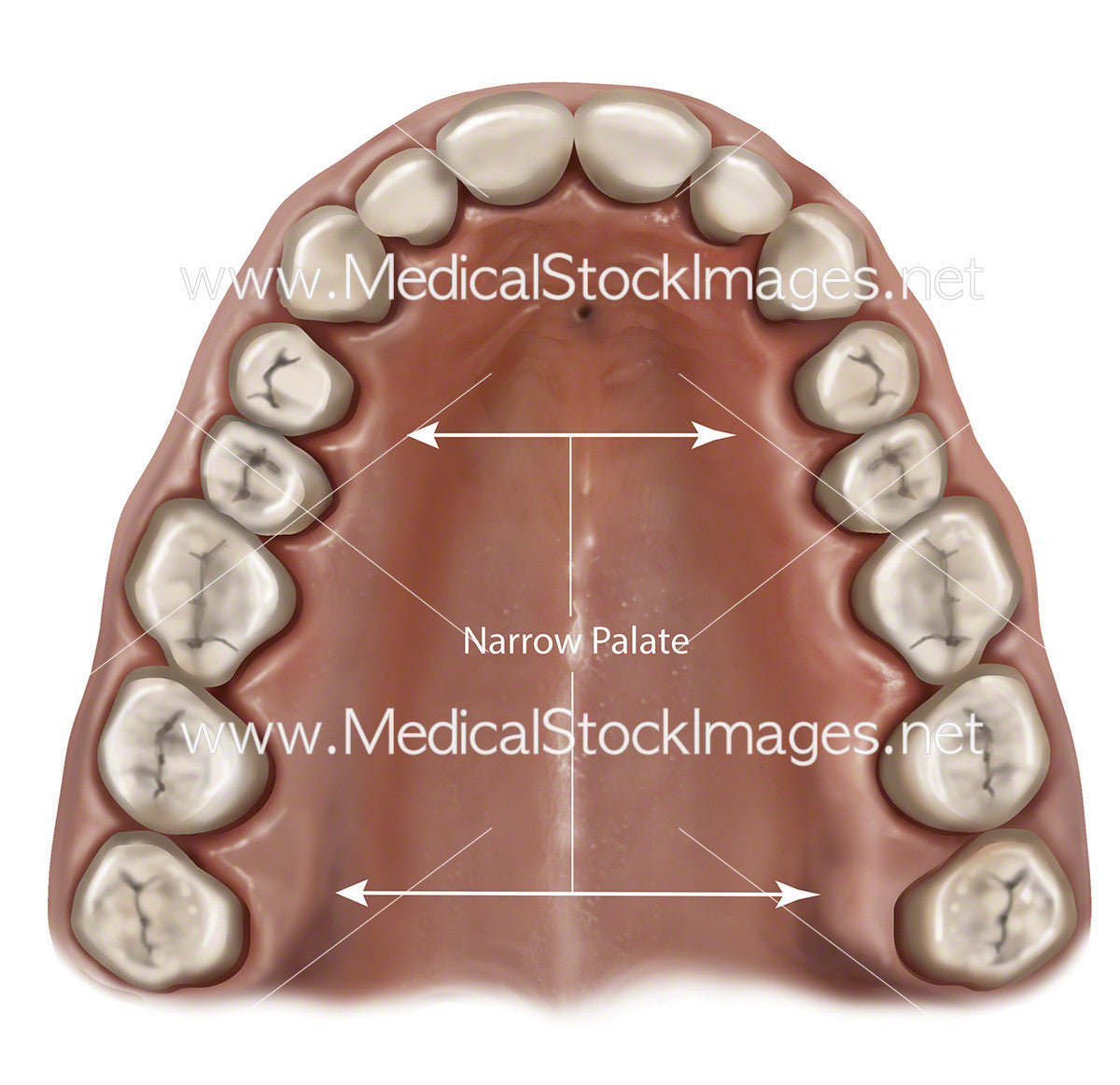 11565 narrow palate PV