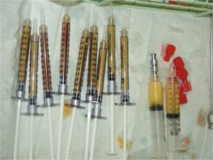 Fat transfer procedure los angeles
