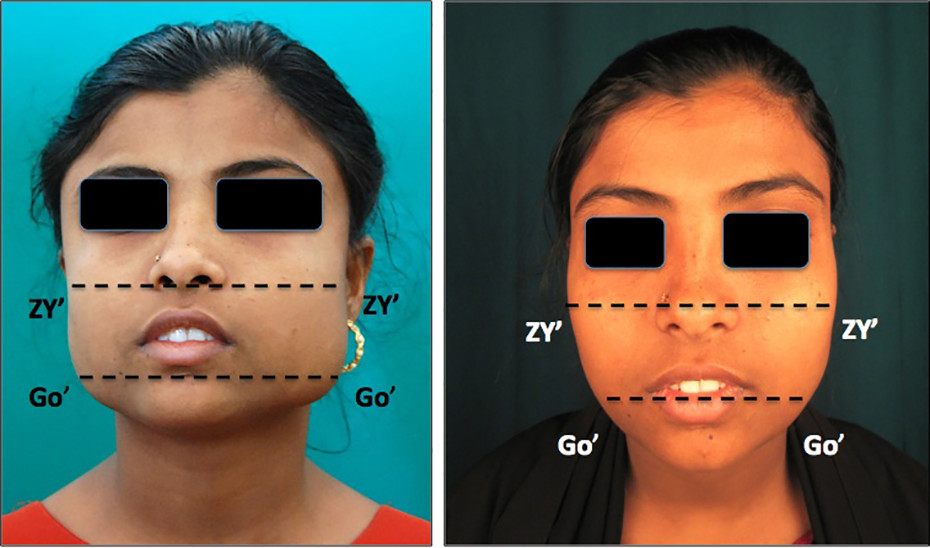 Masseter hypertrophy sage journals