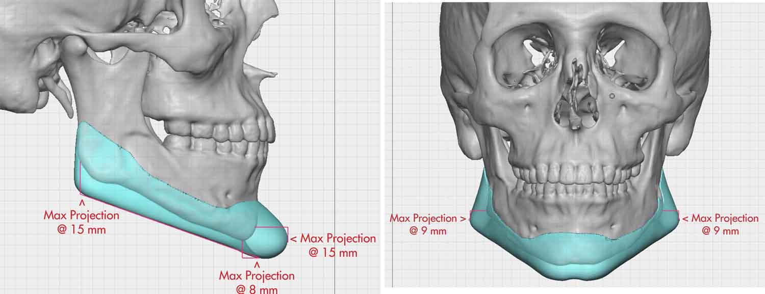 Custm Jawline Implant dimensions Dr Barry Eppley Indianapolis