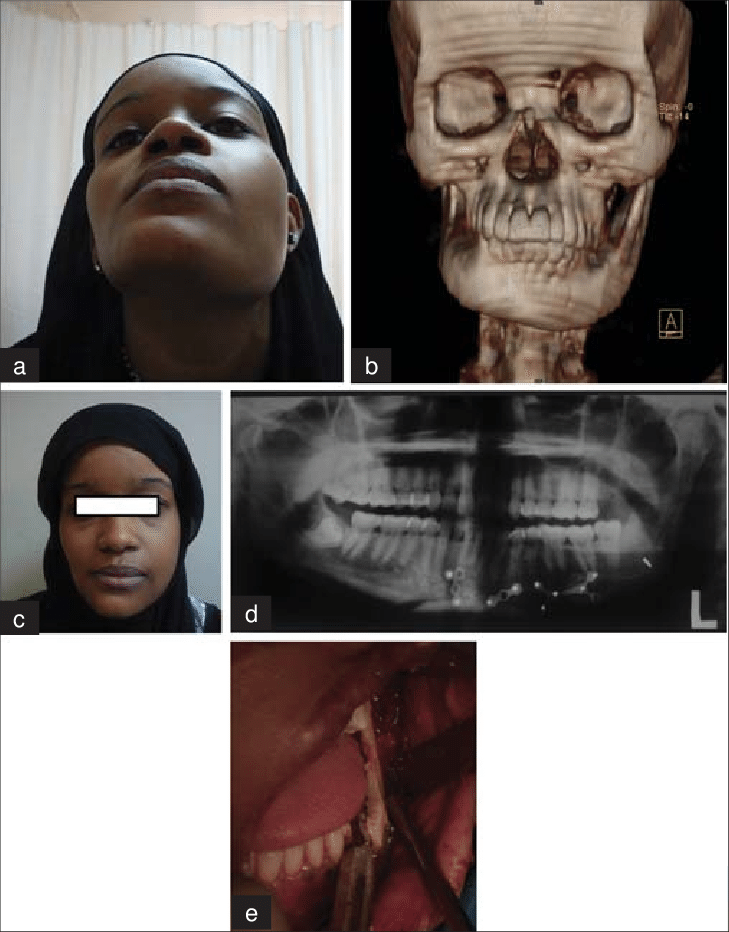 A Clinical picture showing severe left mandibular asymmetry b CT scan showing 3D