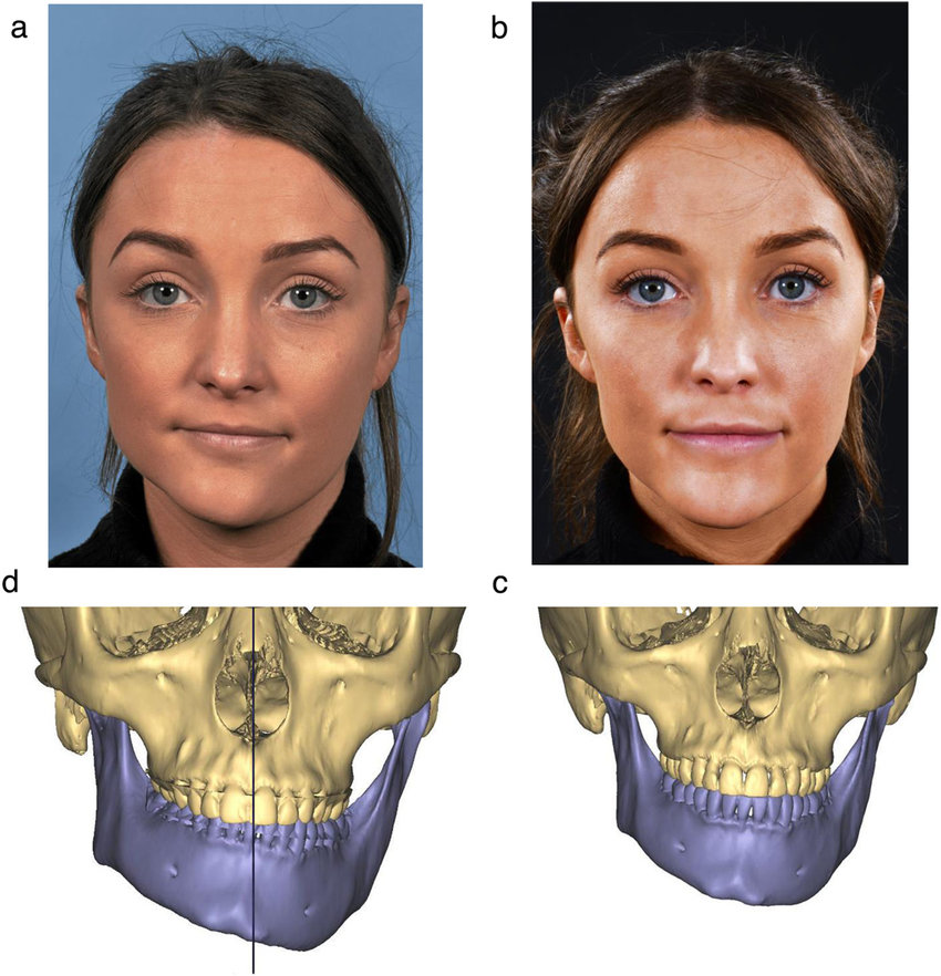 Clinical photographs and 3 dimensional virtual reconstructions of patient with left sided