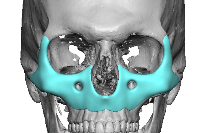 3534627 midface implant 2 male custom midface implant design front view