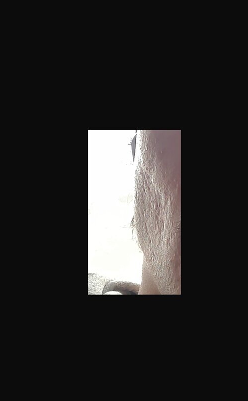 acne scar.jpeg