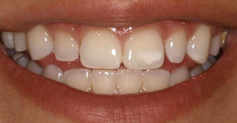 restoring-demineralized-tooth-enamel.jpg